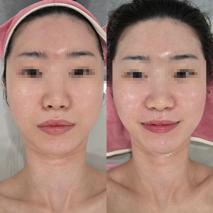  인천 논현 피부관리 에스테틱 속건조 해결 피부광채까지 얻은 온더스킨케어 미백재생관리 상세후기 주차가능