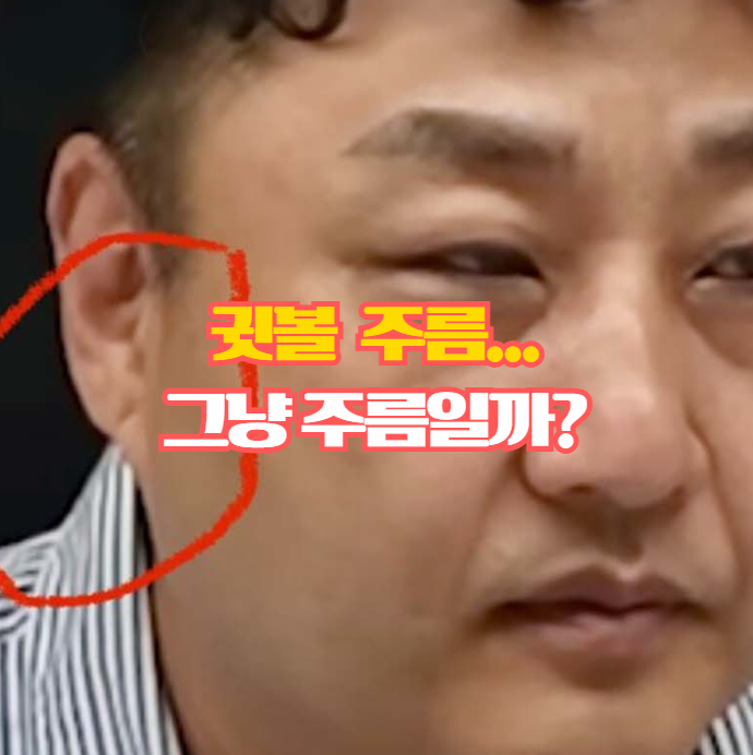  프랭크징후 아시나요? 귓볼 사선주름이 말해주는 건강 신호