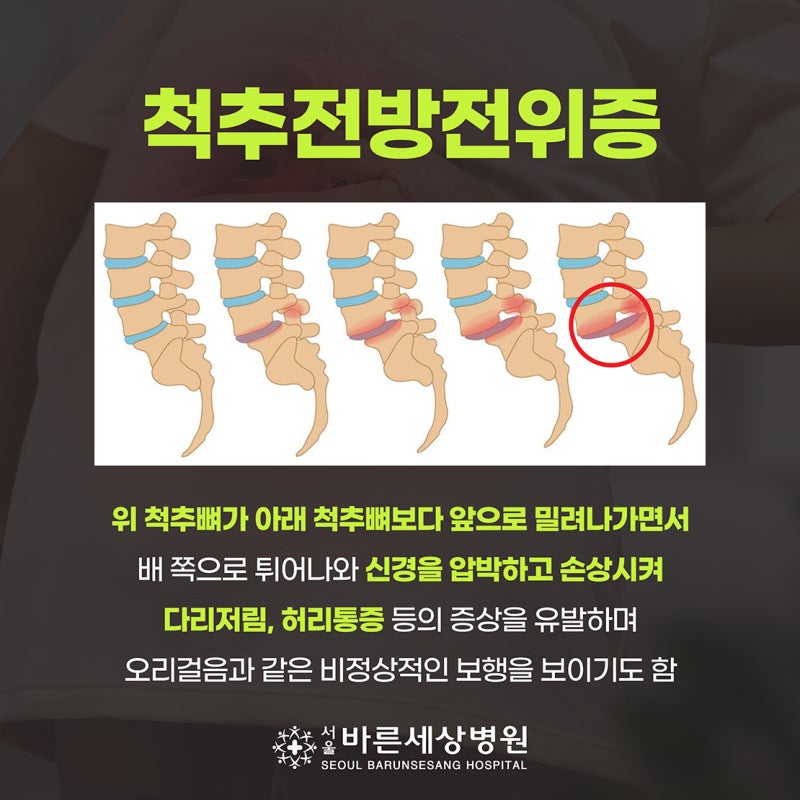 허리 통증의 원인? ‘척추전방전위증’ 제대로 알아보기