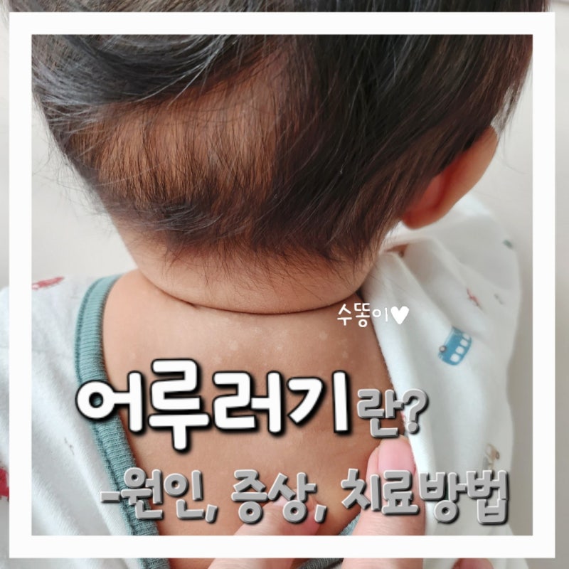 [4개월 아기 어루러기] - 어느날 갑자기 올라온 피부 백색반점/ 어루러기 원인, 증상, 치료방....