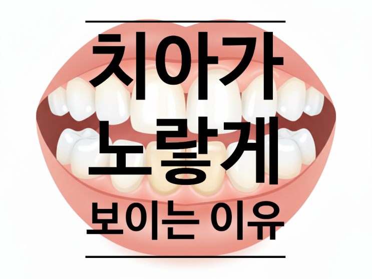  영구치 앞니 색상, "새로 나온 앞니가 왜 이렇게 누렇죠?" 치아 색상의 진실과 오해, 속 시원히 알려드립니다.