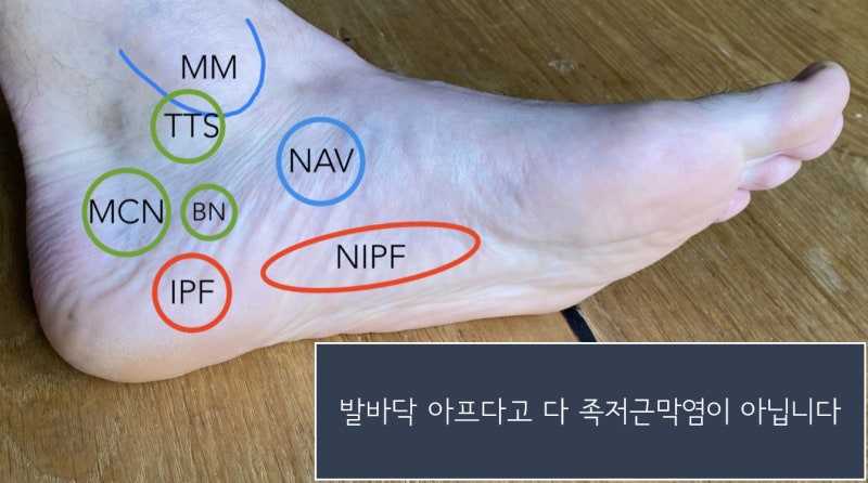하남족저근막염 한의원 봉침약침 치료