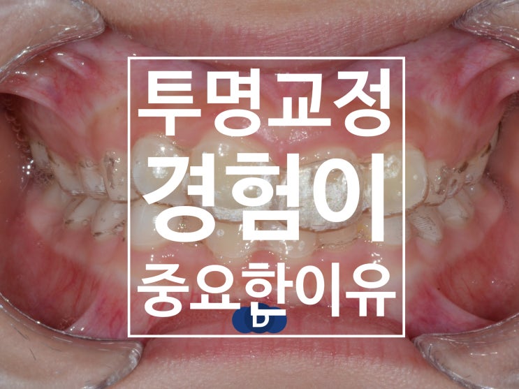  하남 투명 교정(인비절라인)의 숨겨진 비밀: 왜 '경력 있는 전문의'의 선택이 가장 중요한가? 심미성과 기능성을 모두 잡는 성공적인 투명 교정의 핵심 열쇠