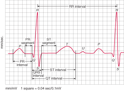 EKG (Electrocardiogram) 심전도 검사 방법, 해석