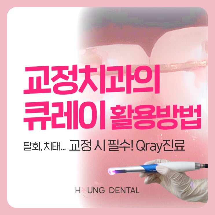 수원 팔달구 치과에서 알려주는 교정시, 큐레이의 쓰임새