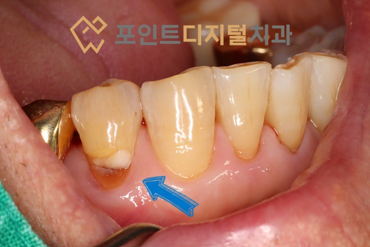  [탕정치과]  치경부 우식 레진 치료 후 8개월 경과 / 천안 아산