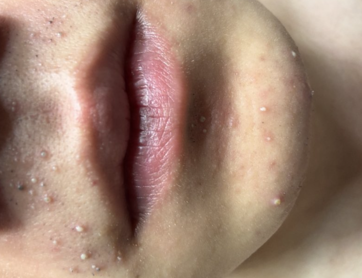  세종레이저제모 부작용 이제 진정됫네요 (필독)