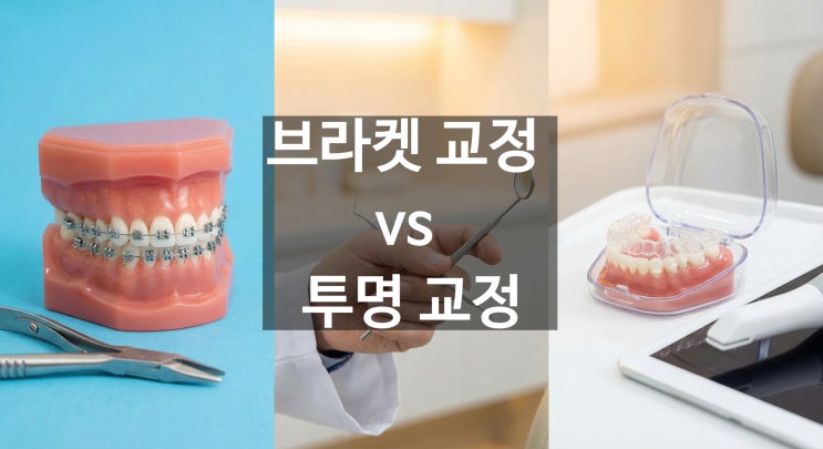  우리 아이 교정, '철사'냐 '투명'이냐 고민되시죠? (하남 & 양평 성장기 교정의 기준)