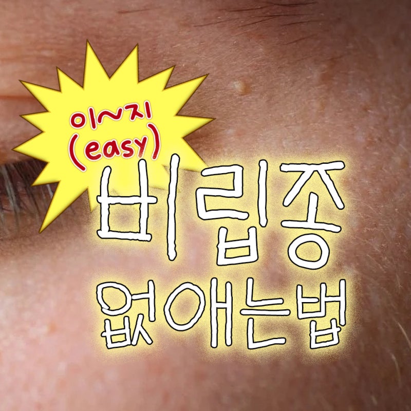 얼굴 눈가 비립종 원인은? (피부과 제거 후기 가격, 셀프 압출 방법)