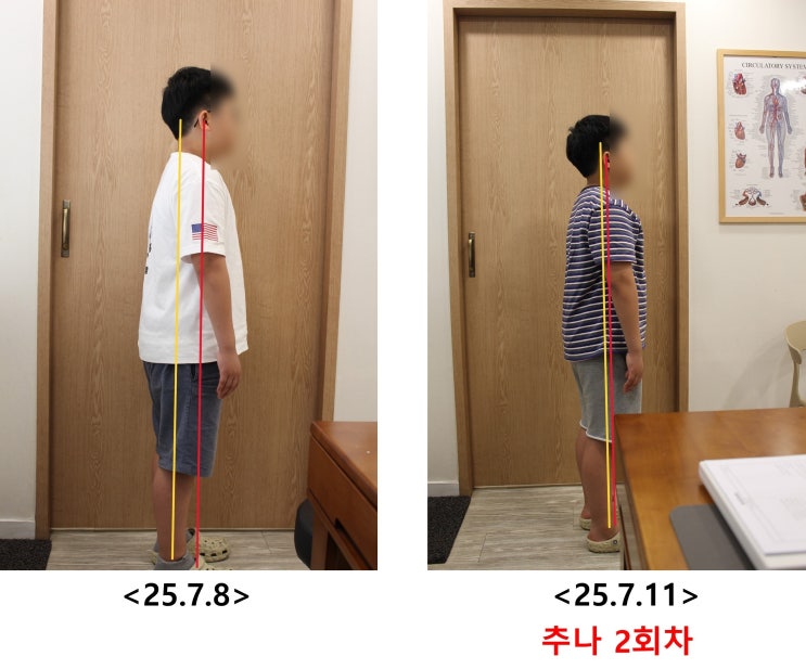  성장기 아이에게 자세교정(체형교정)이 필요한 이유