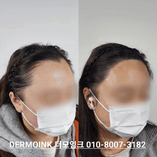  강남 헤어라인 커버, 혹시 10년 더 늙어 보이진 않나요? (여성 헤어라인 채우기)