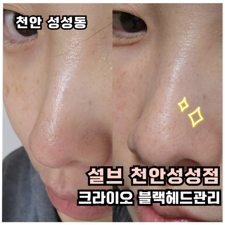  [천안 피부관리]블랙헤드 모공·피지 맞춤관리 성성동 피부관리 설브