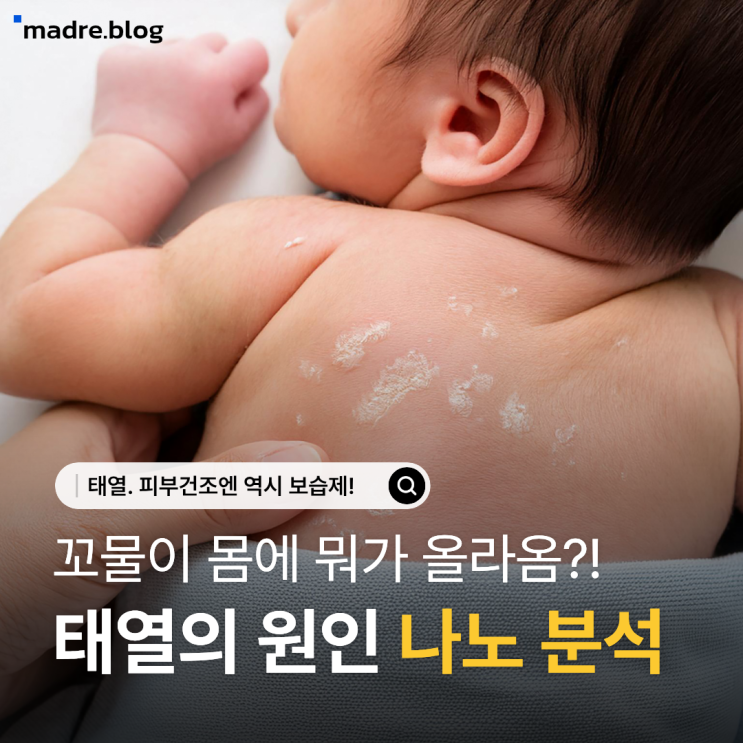  신생아 태열은 온도, 음식, 정서랑도 관련 있다고? 어림도 없지