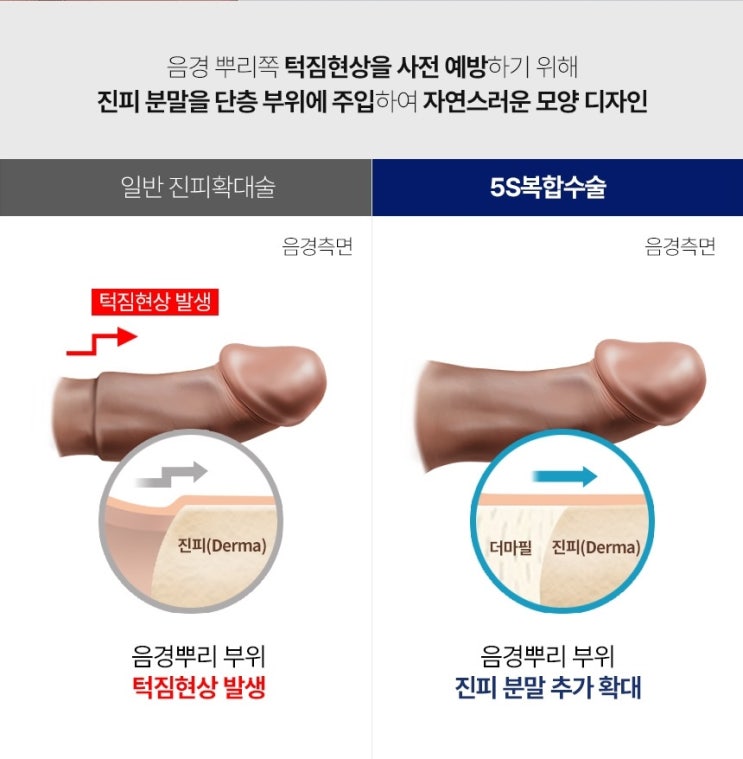  [6년 연속 1위인 이유!]레이저 조루수술, 재건수술, 다이아몬드 길이연장 남성 확대수술 (1:1 환자 맞춤)