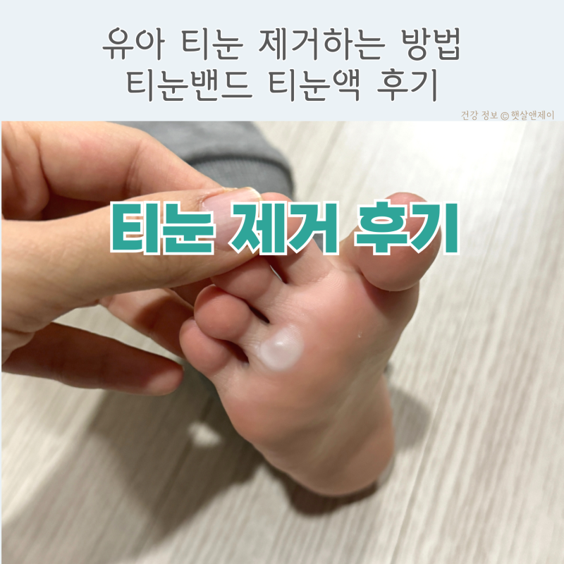어린이 유아 발바닥 티눈 밴드 연고 사용 제거 후기