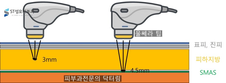 울쎄라 효과 보완, 슈링크 6mm - 삼성동피부과전문의 닥터림