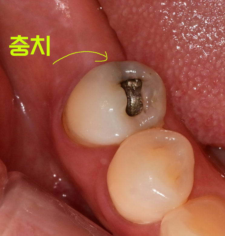  아말감 했던 치아, 충치 생겨서 레진빌드업으로 치료한 케이스