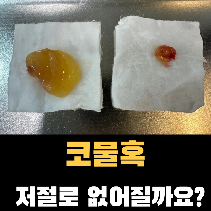  코물혹은 자연적으로 없어질까요? 많은 분들이 오해하는 부분
