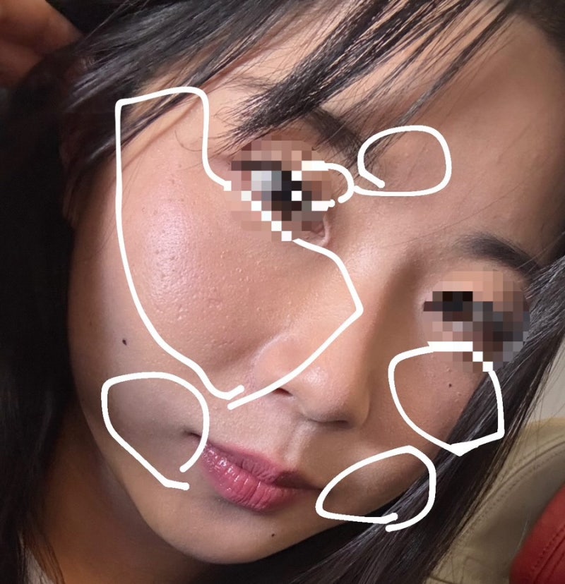 비립종 편평사마귀 레이저 제거 후기