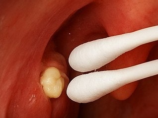 편도결석 원인 제거 가글 어떻게 빼야하나