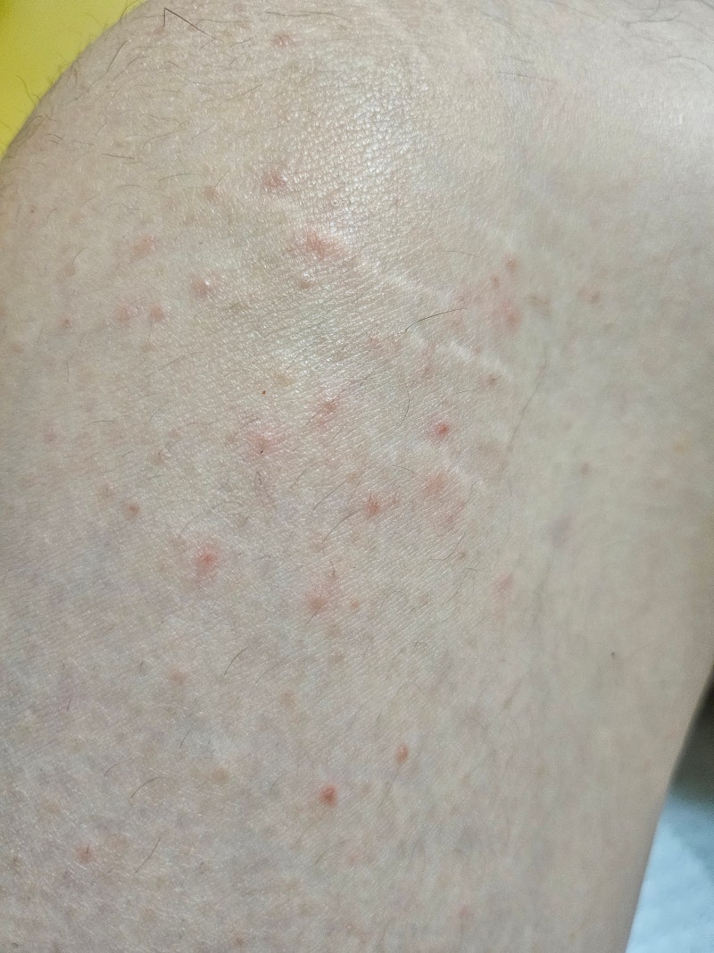 [건강] 겨울철 피부 한랭 두드러기 예방과 치료방법 수분채우기 !!