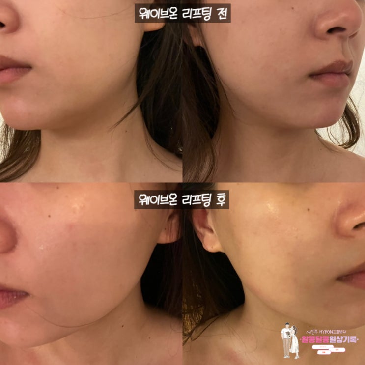  낙성대 피부관리 잘하는 '오드리피부연구소'에서 웨이브온 리프팅받고 왔어요!
