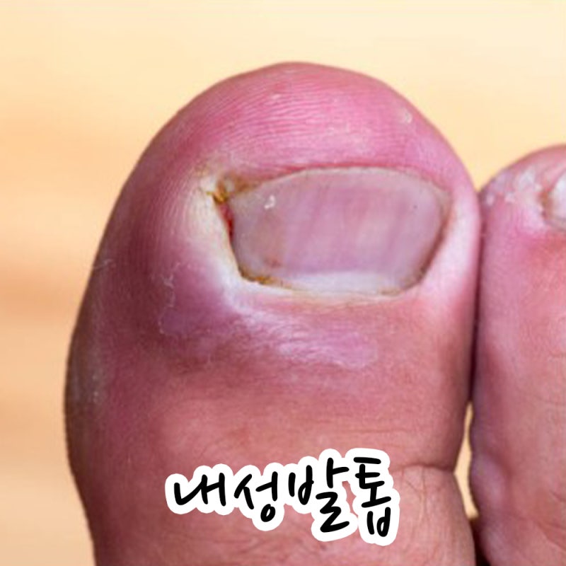 내성발톱 염증 고름 증상 원인 자가 치료 연고 종류