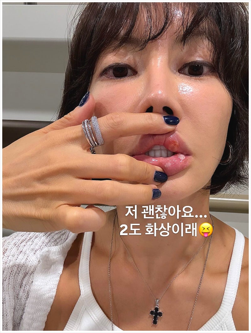 입술수포, 헤르페스일까? 증상과 연고·약 정보까지 한눈에