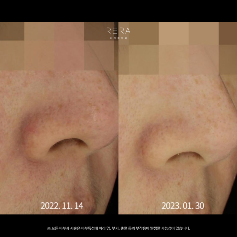 청담피부과 딸기코 치료_주사비 증상 원인 및 레이저 치료 방법