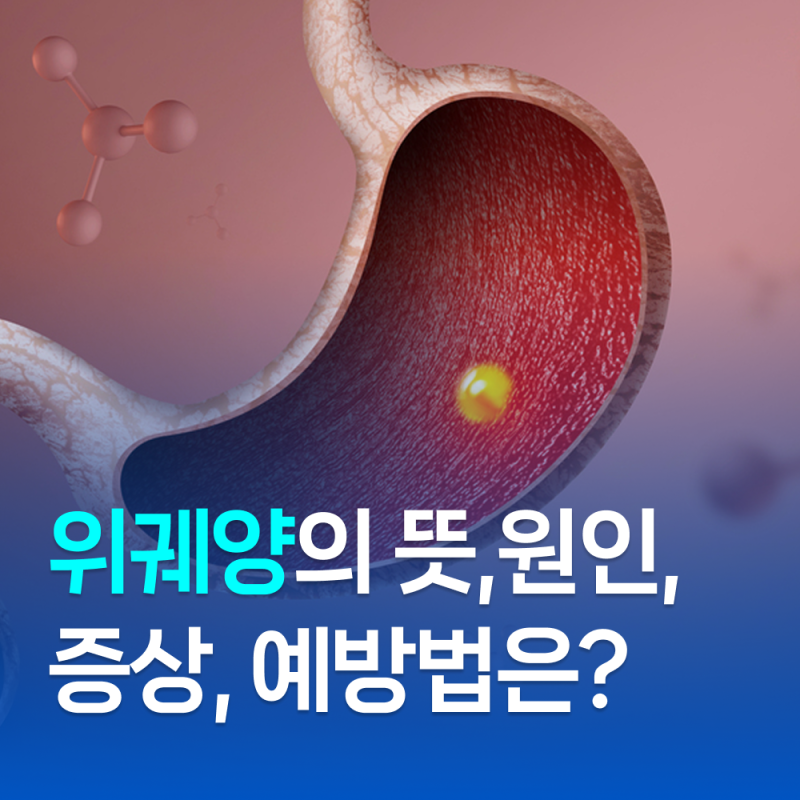 위궤양의 뜻, 원인, 증상, 예방법까지 알기 쉽게 정리