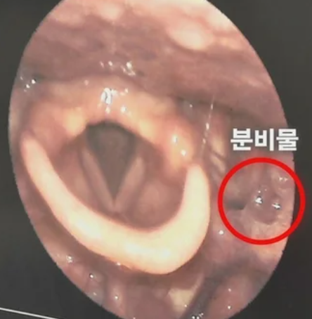 후비루염, 감기 아닌데 목이 답답했던 진짜 이유 (실제 경험담)