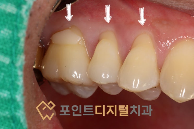  [탕정치과]  치경부 마모증(NCCL) 레진 치료 / 천안 아산