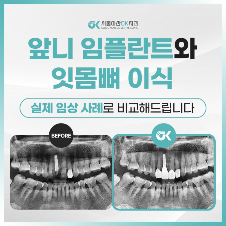  [임상사례] 양평치과추천, 앞니 임플란트와 잇몸뼈 이식