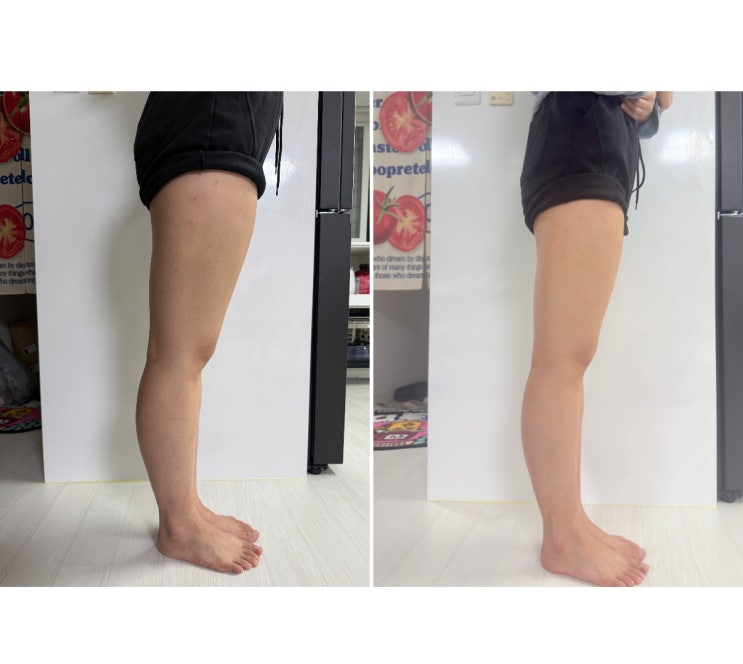  신사 허벅지지방분해주사 효과 제대로 본 후기 -4kg 비만클리닉 5회차·종아리 3회차