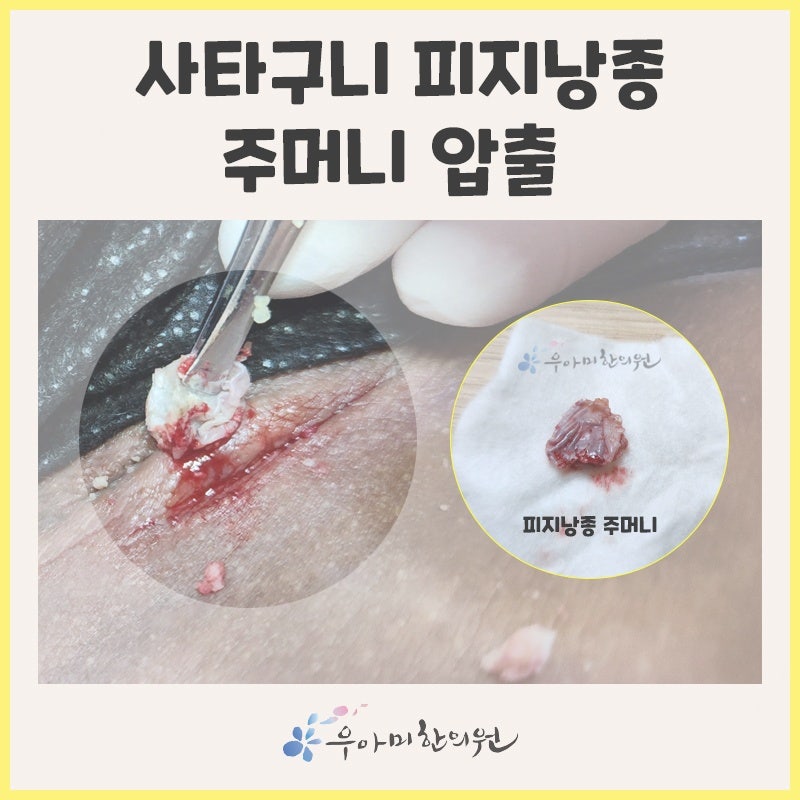 사타구니 멍울 산부인과 회음부 종기 대처가 어렵다면?