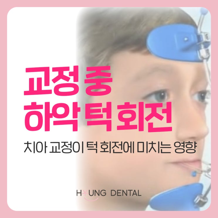  수원 치아교정 중 턱의 회전이 고민이라면?