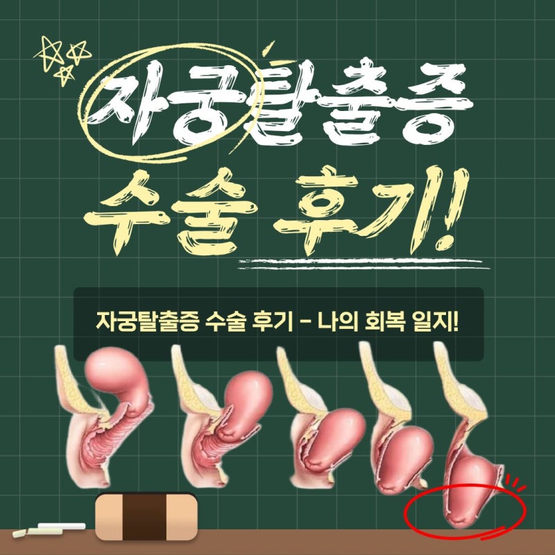 자궁탈출증 수술 후기 - 나의 회복 일지!