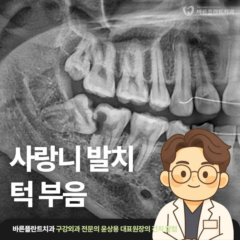 사랑니발치 후 출혈 통증 목 부음?