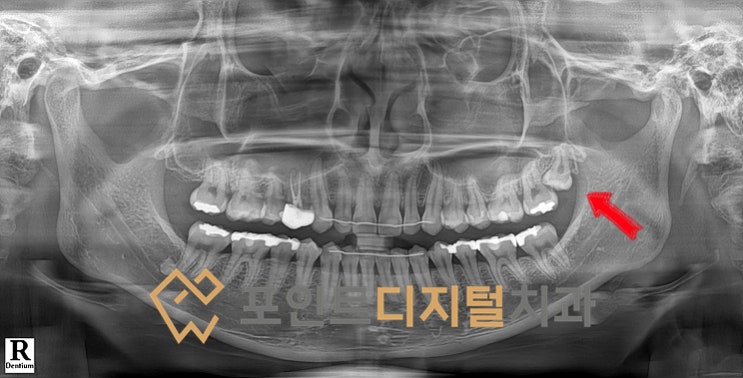  [탕정치과]  타치과 위생사 선생님의 매복 사랑니 발치 / 천안 아산 불당 배방