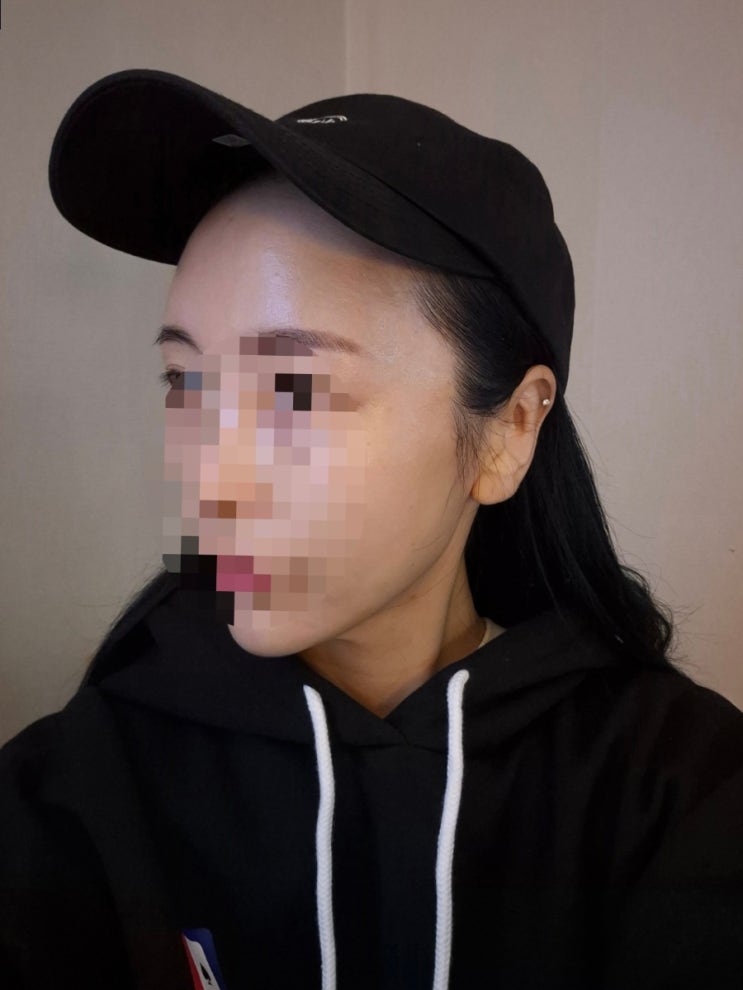  압구정 피부과 역시 좁쌀여드름엔 리쥬란이 최고