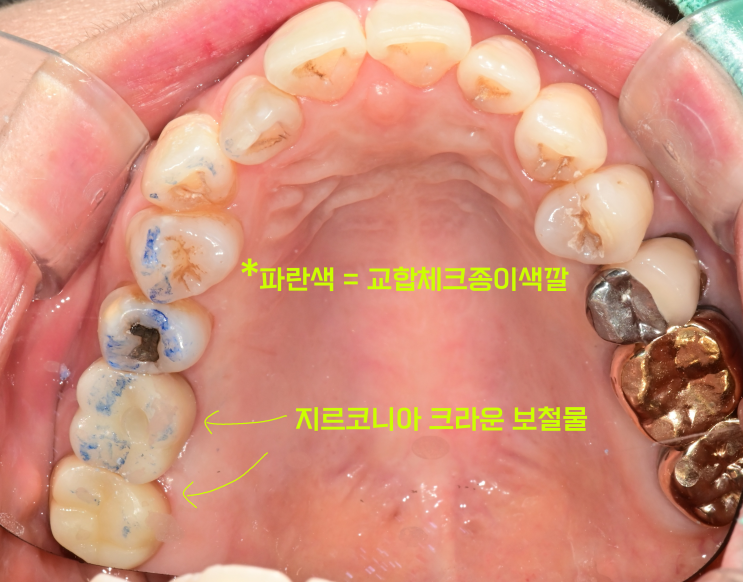  크라운이 밥먹다가 빠졌는데 다시 붙일수 있을까요? 아니면 치료를 해야되나요?