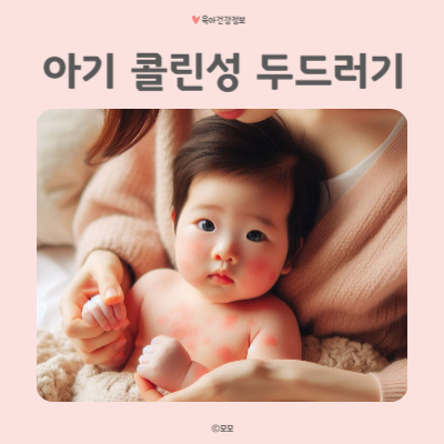 아기 콜린성 두드러기 열꽃 원인 확인해요.