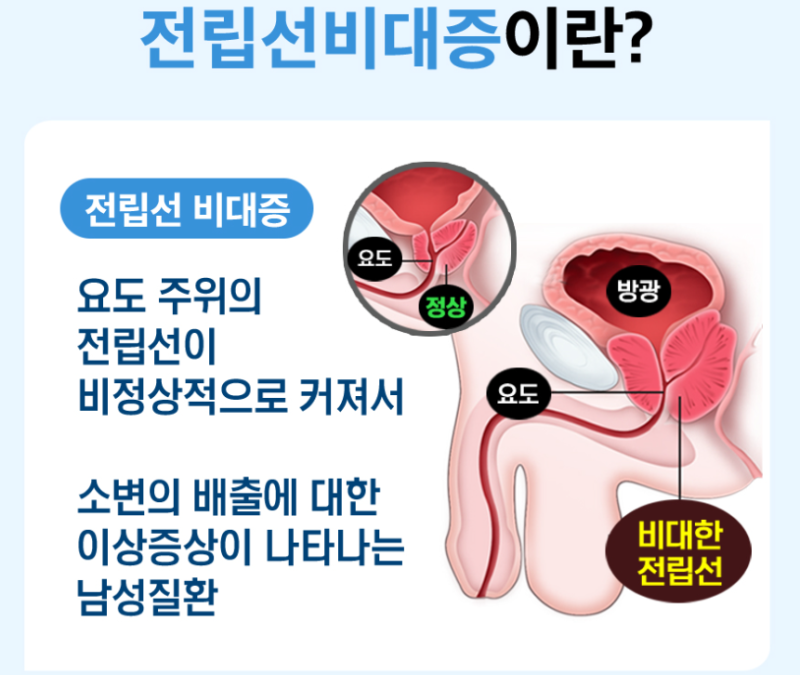 전립선비대증 원인·증상·치료방법·약 부작용까지 한 번에 정리