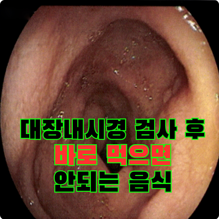  대장내시경 검사 후 식사 언제부터? 먹을 수 있는 음식은(용종제거했다면?)
