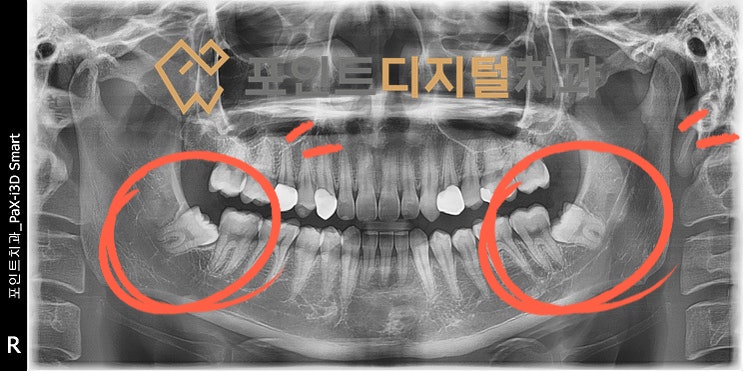  [탕정치과]  매복 사랑니 발치 / 천안 아산 불당 배방