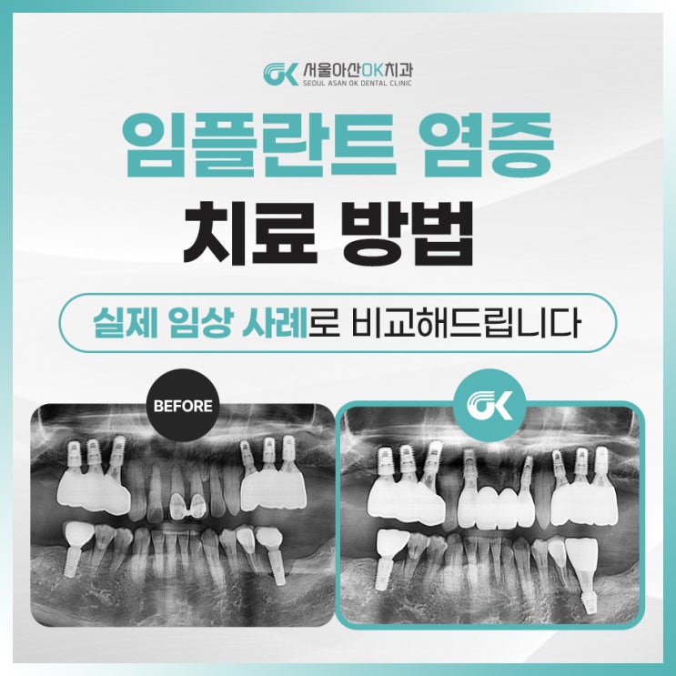  [임상사례] 양평양심치과, 임플란트 염증 치료