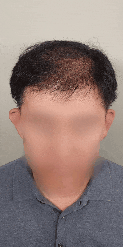  수원 두피 커버, 숱 적은 정수리 가르마 고민 채움 후기 (자연스러움의 비밀)