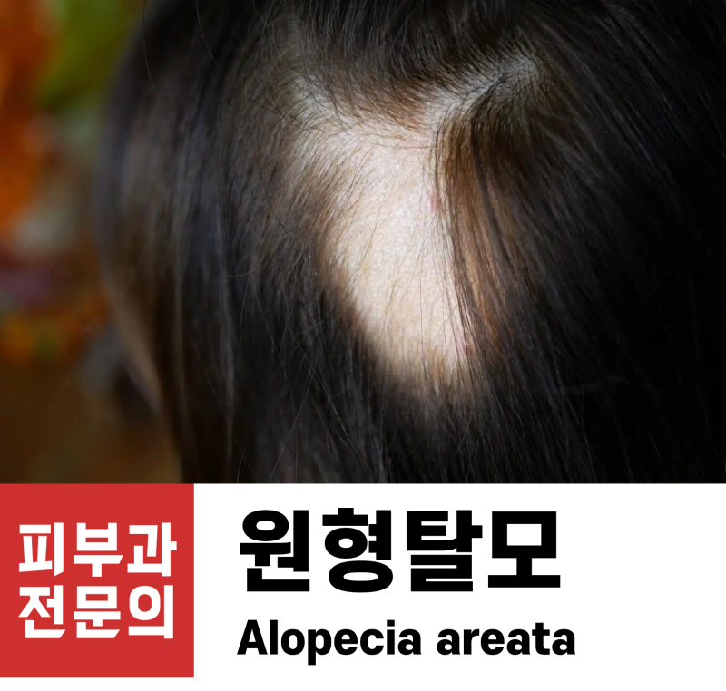 원형탈모, 누구에게나 생길 수 있습니다.