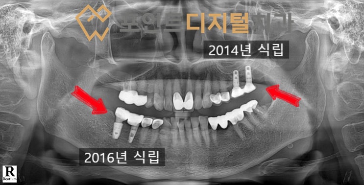  [탕정치과] 임플란트 11년 경과(짐머 TSV) / 천안 아산