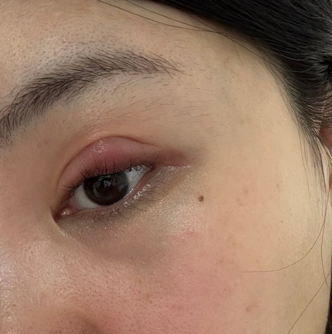 안과 눈다래끼 째기 고통, 다래끼 보험청구가능